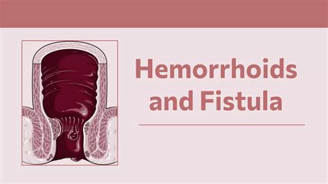 Piles Hemorrhoids Fistula at David Greenfield blog