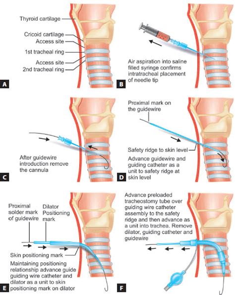Image result for Trach Procedure