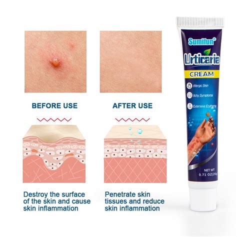 Buy Urticaria Antipruritic Cream 20g Natural Herbal Anti Itch Ointment ...
