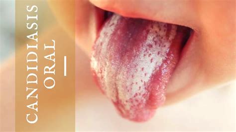 Candidiasis oral | Clínica Dental Smile | Clínica Dental Smile