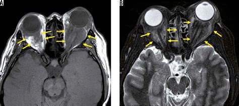 Does Mri Show Nerve Problems