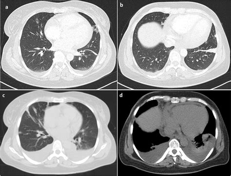 Chest CT scans. Chest CT scan with contrast medium (a,b) and follow-up ...