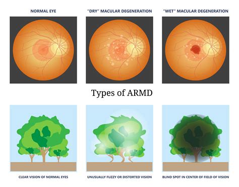 Age-Related Macular Degeneration (ARMD): Symptoms, Causes, Tests, & Treatments | Goyal Eye