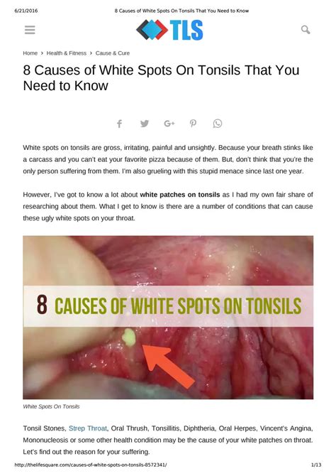 White Spots On The Back Of Your Tonsils at Kai Wieck blog