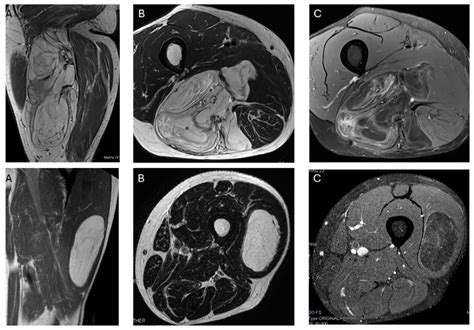 Differentiation of Atypical Lipomatous Tumors from Lipomas: Our Experience with Visual Analysis ...