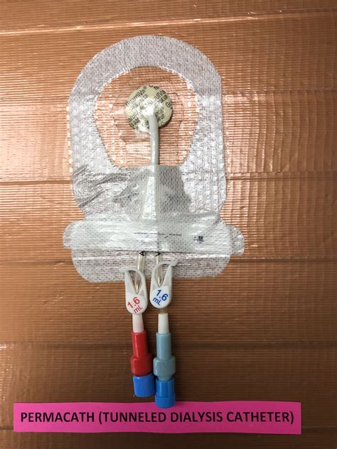 Dialysis Catheter To Chest at Linda Redmon blog