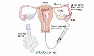 Image result for IUI