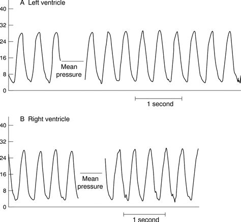 Intracardiac pressures in the human fetus | Heart