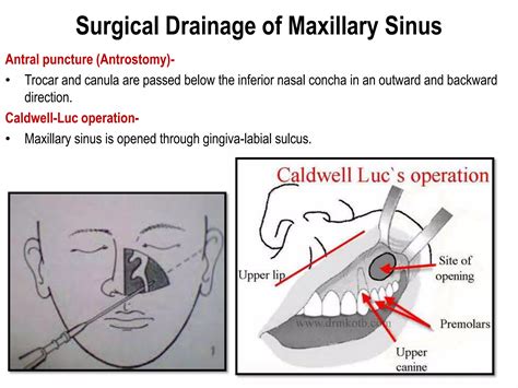 paranasal_air_sinuses.pptx