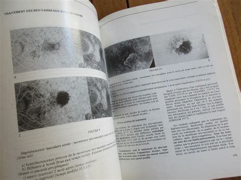 Ophthalmology Choroid Vascularization 1981 Eye | Ubuy India