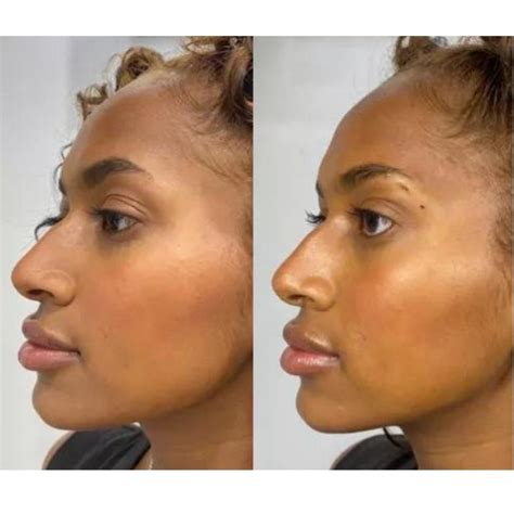 Image result for Fox Eye Thread Lift Procedure