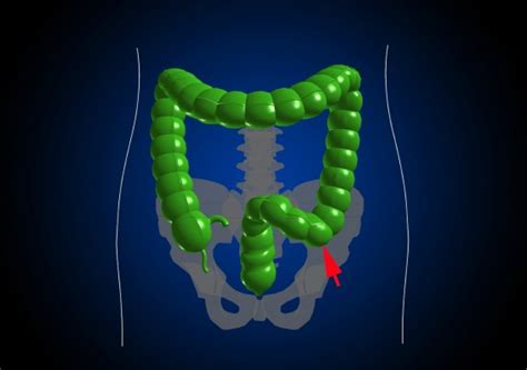 Image result for Colonoscopy Sigma Loop