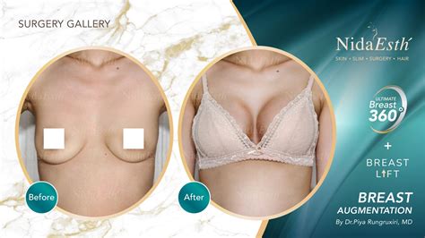 Breast augmentation surgery with the Ultimate Breast 360 ° technique