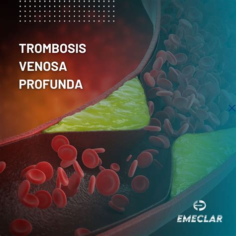 📢La trombosis venosa profunda (DVT, por sus siglas en inglés) se ...