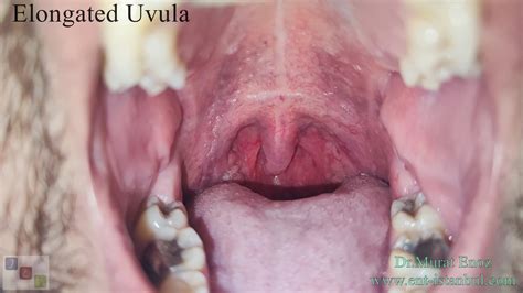 Your "Uvula" Can Tell You a Lot About Whether You Have Snoring and ...