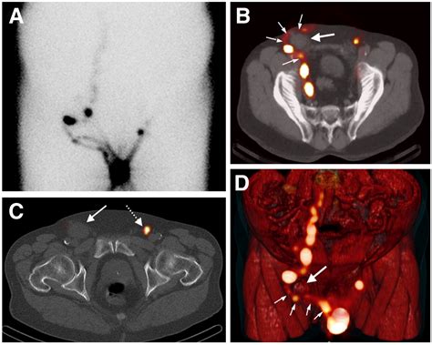 Shotty lymph nodes groin - booyagro