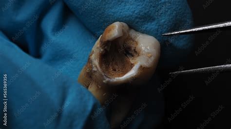 Decayed Tooth Pulling 的图像结果