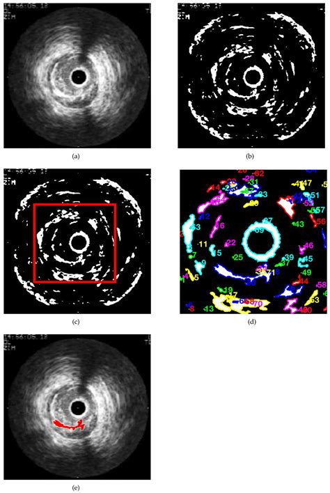 Semi-Automatic 3D Reconstruction of Atheroma Plaques from Intravascular ...