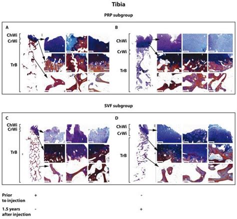 Long-Term Structural Changes in the Osteochondral Unit in Patients with ...