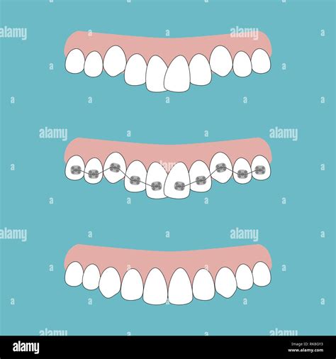 Brace shape Stock Vector Images - Alamy