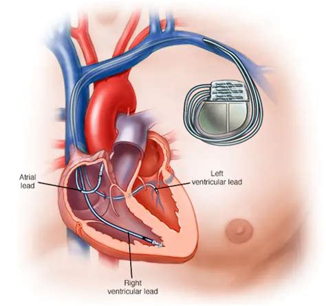 Image result for Installing Pacemaker