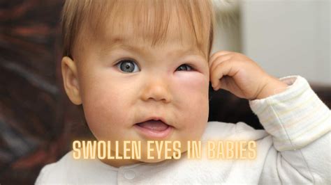 Baby Puffy Red Eyes at Anthony Monroy blog