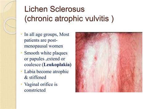 Diseases AND PATHOLOGY of Female Genital Tract1.ppt