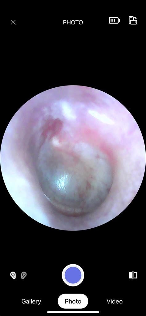 Are my ear drums damaged? : r/earwax