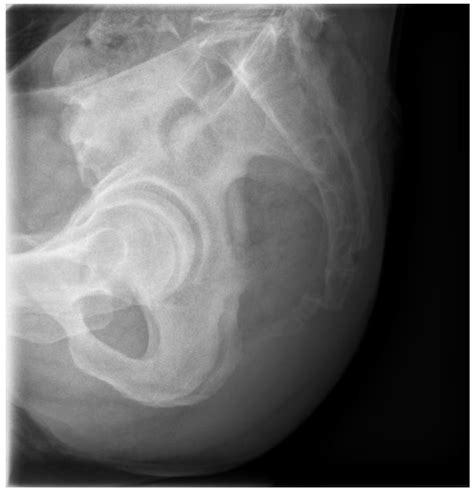 Minimally Invasive Open Reduction and Maintenance Technique for ...