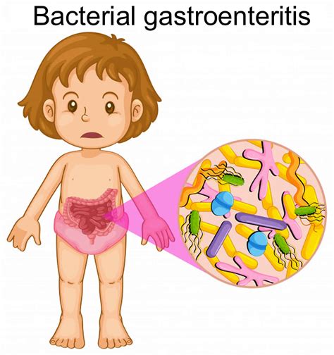 Bacterial gastroenteritis causes, symptoms, diagnosis, treatment & prognosis
