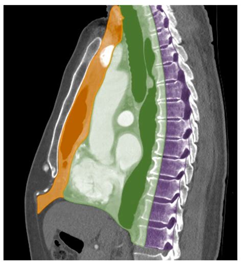 Approach to Imaging of Mediastinal Masses