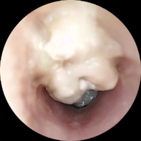 Image result for Giant Abscess Exploding On Back