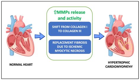 Metalloproteinases and Hypertrophic Cardiomyopathy: A Systematic Review