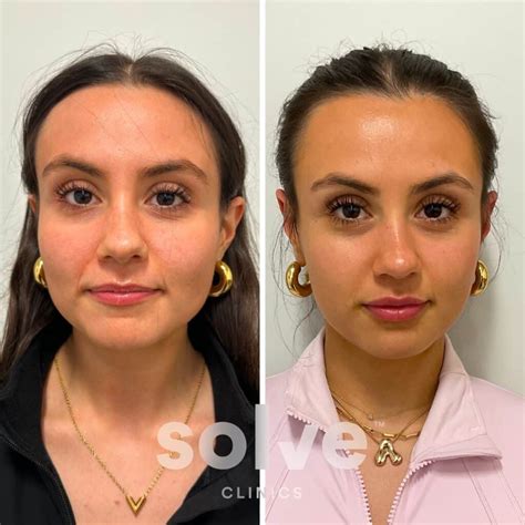Masseter Botox Transform Your Jawline: Masseter Botox Benefits