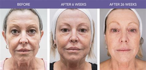 https://www.heritagehealers.com/wp-content/uploads/2022/10/before-and-after-face.jpg