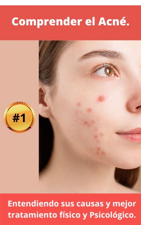 Comprender el acné, tratar y superar la batalla: recupere su confianza ...