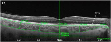 Changes in Choroidal Thickness and Retinal Activity with a Myopia ...