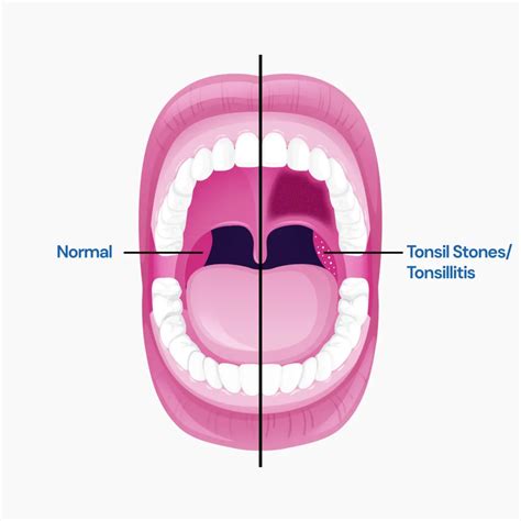 Tonsil Stones vs Strep: Is There A Difference?