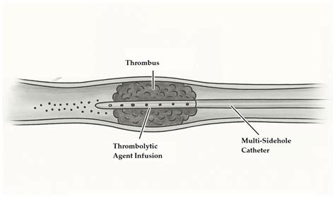 Catheter-Directed Thrombolysis vs. Anticoagulation in Deep Vein Thrombosis: A Comparative Study