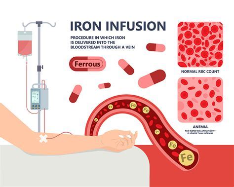 What Causes Joint Pain After Iron Infusion