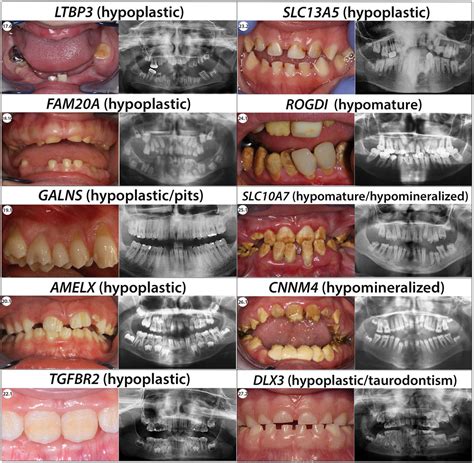 Frontiers | Amelogenesis imperfecta: Next-generation sequencing sheds ...