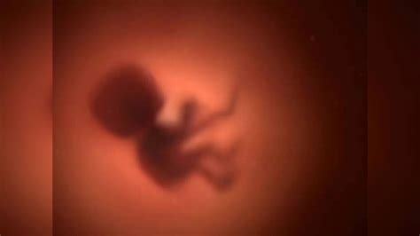 Ranchi: 8 fetuses found inside 21-day-old baby's stomach in extremely ...