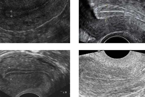 Uterine Lining Thickness