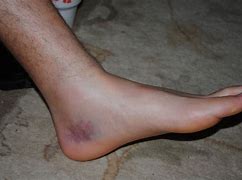 Image result for sprain