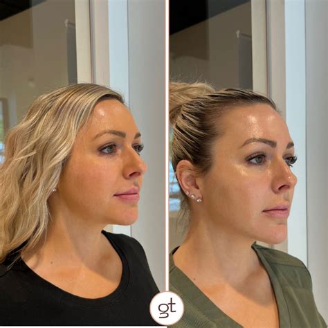 Before and After Gallery Dermal Fillers - Stunning Transformations