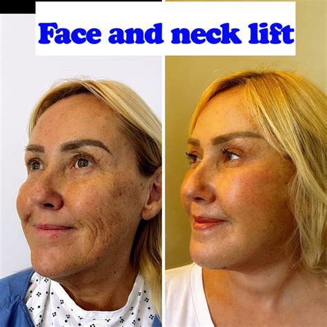 Non-Surgical Vs. Surgical Facelift London, UK: We Answer 5 FAQ's