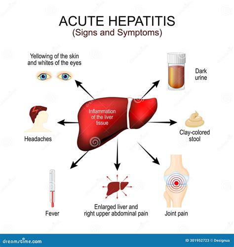 Hepatitis Symptoms stock vector. Illustration of damage - 301952723