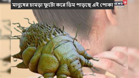 Scabies Disease: মানুষের চামড়া ফুটো করে ডিম পাড়ছে এই পোকা! ভয়ঙ্কর ...
