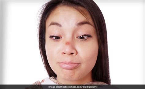 एक या दो नहीं 6 तरीकों के होते हैं पिंपल्स, जानें कैसे करें इन्हें ठीक ...