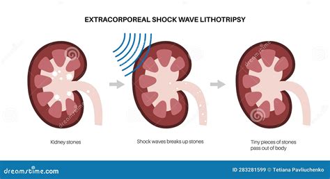 Lithotripsy Procedure 的图像结果
